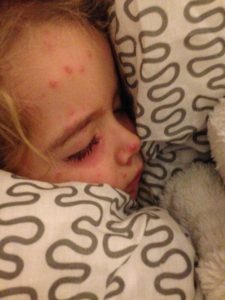 Chickenpox symptoms |top tips for dealing with Chicken pox